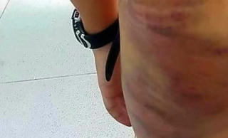 Khởi tố vụ án mẹ kế đánh con chồng nhiều vết bầm tím trên người