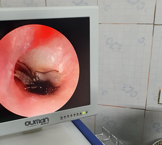 Sản phụ suýt thủng màng nhĩ vì bị gián chui vào tai