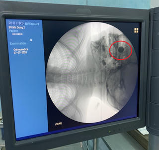 Bé 4 tuổi bị axit phá hủy hốc mũi do nghịch pin