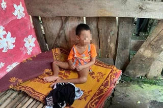 Nghệ An: Đứa trẻ bị 'bỏ rơi' dẫn đến hoại tử xương cụt, lở loét phần đùi