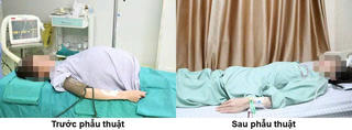 Người phụ nữ mang khối u khổng lồ 15kg được phẫu thuật thành công