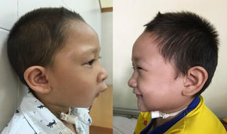 Huế: Phẫu thuật mặt thành công cho những trẻ em bị dị tật bẩm sinh