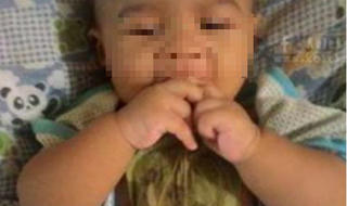 Đắp lá chữa sổ mũi, bé gái 6 tháng tuổi bỏng nặng vùng ngực