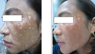 Hoảng hồn gương mặt lốm đốm vì đắp lá trầu làm đẹp