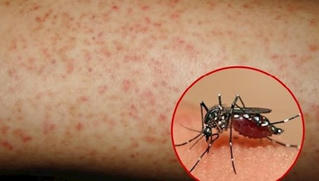 Cách phân biệt sốt xuất huyết với sốt virus thông thường