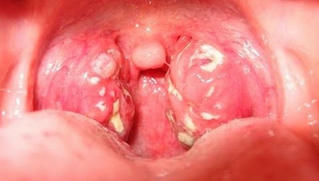 Đừng để viêm Amidan biến chứng nguy hiểm ở trẻ nhỏ