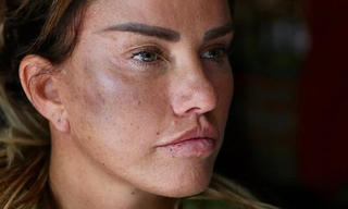 Người mẫu 'bốc lửa' Katie Price bị trộm đánh thâm tím mặt