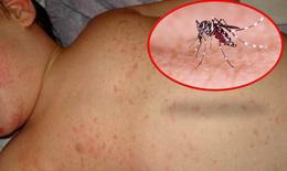 Cảnh giác với biến chứng của bệnh sốt xuất huyết Dengue