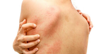 Vì sao nổi mụn đỏ đầy lưng sau khi khỏi COVID-19?