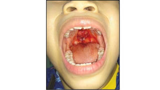 Liên tiếp trẻ rách vòm miệng phải cấp cứu mùa dịch, bác sĩ hướng dẫn cách xử trí