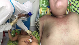 Bé trai bị giãn mạch vành sau khi vừa khỏi COVID-19