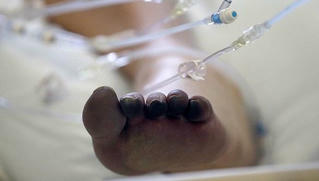 Hiện tượng 'ngón chân COVID' có thực sự do virus SARS-CoV-2 gây ra?