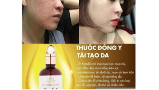 Tinh chất mụn ACNE SKIN SERUM 'nổ' như thuốc đông y điều trị?
