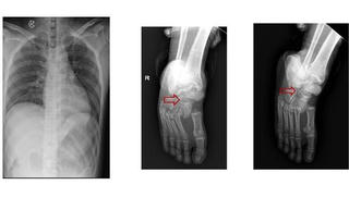 Thang máy rơi từ tầng 7 ở TP HCM, hai thanh niên bị liệt 2 chân