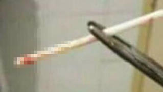 Hàng chục phụ nữ bị lừa cấy que kẹo mút thay cho que tránh thai