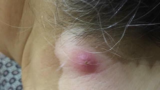 Nằm viện cả tháng vì chủ quan với nhọt nhỏ sau gáy