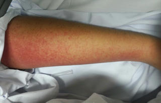 Người phụ nữ 'sốc' phản vệ nặng khi uống thuốc chống say xe