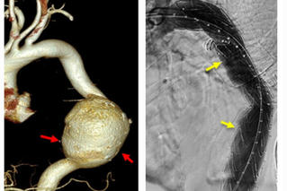 Cứu bệnh nhân người Campuchia vỡ phình khổng lồ động mạnh chủ ngực 