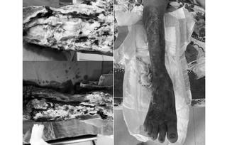 Loại vi khuẩn cực độc 'ăn mòn' cẳng chân người đàn ông