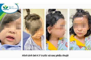  Bé gái có khối u hắc tố khổng lồ trên mặt