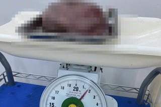 Cắt bỏ khối u gần 2kg cho sản phụ 19 tuổi