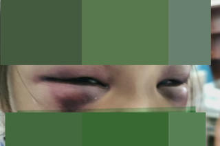 1 giáo viên 'tác động vật lý' khiến nữ sinh tiểu học bầm tím 2 mắt