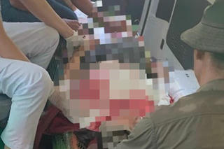 Một phụ nữ vào rừng làm thuê bị đá rơi chấn thương sọ não 