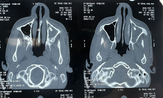 BV Trung ương Huế ứng dụng kỹ thuật cao lấy dị vật bịt lỗ thông xoang hàm 