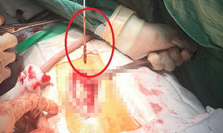 Gắp con dao dài 13cm nằm trong cơ thể chiến sĩ công an 11 năm