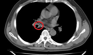 Một tháng sau bữa cháo gà, mới phát hiện mẩu xương trong phế quản