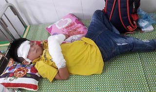 Điện thoại phát nổ, bé trai nát 2 bàn tay