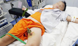 Trèo cây chơi trốn tìm, bé trai 9 tuổi ngã xuống bị cọc sắt nhọn đâm xuyên đùi