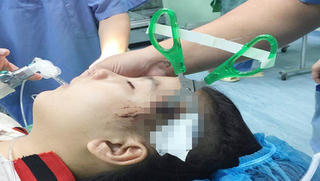 Cấp cứu nữ sinh lớp 5 bị kéo găm vào đầu 3cm khi chơi đùa