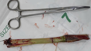 Dị vật dài cả gang tay dưới da bụng bé trai 8 tuổi 