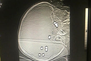 Bé trai 6 tuổi nghịch súng bị đạn bắn xuyên đầu đã tử vong