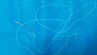 Bé 12 tuổi nuốt cả kim và chỉ dài 25cm vào bụng