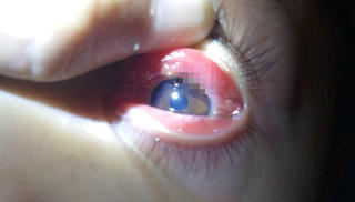 Bắt con vắt ngoe nguẩy trong mắt bé trai 8 tuổi