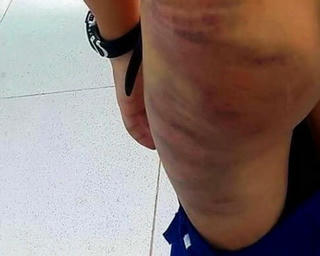 Một học sinh tiểu học ở Cà Mau bị mẹ kế đánh nhiều vết bầm trên người