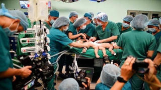 Tách rời thành công hai bé dính nhau