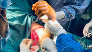 Phẫu thuật ghép nối thành công cánh tay bị đứt lìa