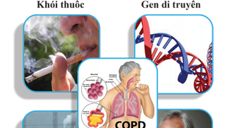 Gánh nặng bệnh phổi tắc nghẽn mãn tính