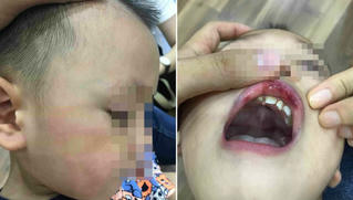 Cô giáo tát học sinh bầm tím mặt, tụ máu môi ở Hà Nội