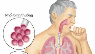 Nấm phổi - căn bệnh nguy hiểm ít người biết 