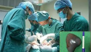 Gia tăng bệnh nhân ung thư lá lách 