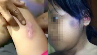 Bé gái 6 tuổi nghi bị cha dượng dí tàn thuốc lá vào người
