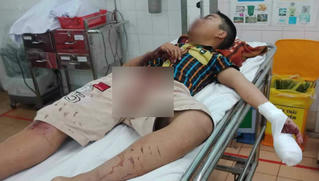 Đốt pháo tự chế, bé trai bị dập nát bàn tay