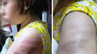 Tạm đình chỉ cô giáo dùng thước nhựa đánh bầm tay học sinh