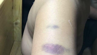 Giáo viên trường Quốc tế Á Châu bị tố đánh học sinh bầm tím tay