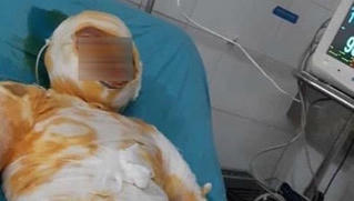 Người vợ bị chồng tẩm xăng đốt ở Thái Bình đã tử vong