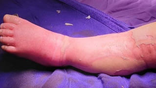 Đắp thuốc lá chữa bỏng, bé 9 tháng tuổi tử vong thương tâm